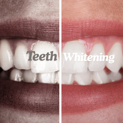 Teeth Whitening Dental Clinics Hong Kong