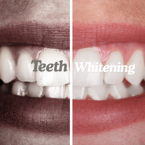 Teeth Whitening Dental Clinics Hong Kong